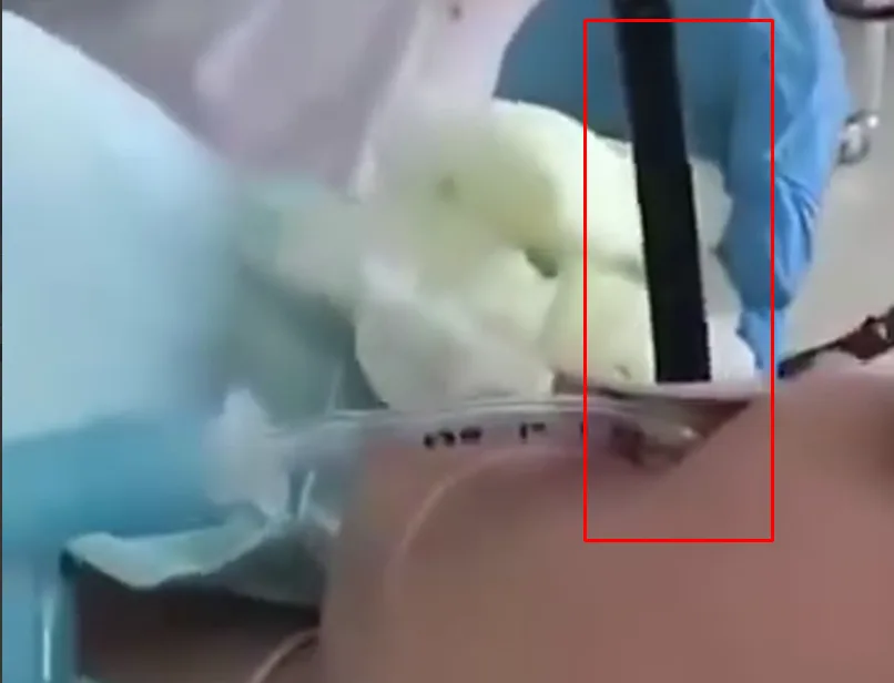 Nga: Một phụ nữ cảm thấy không khỏe sau khi ngủ ngoài trời, bác sĩ rút ra một con rắn dài khoảng 1,2 mét từ họng bệnh nhân